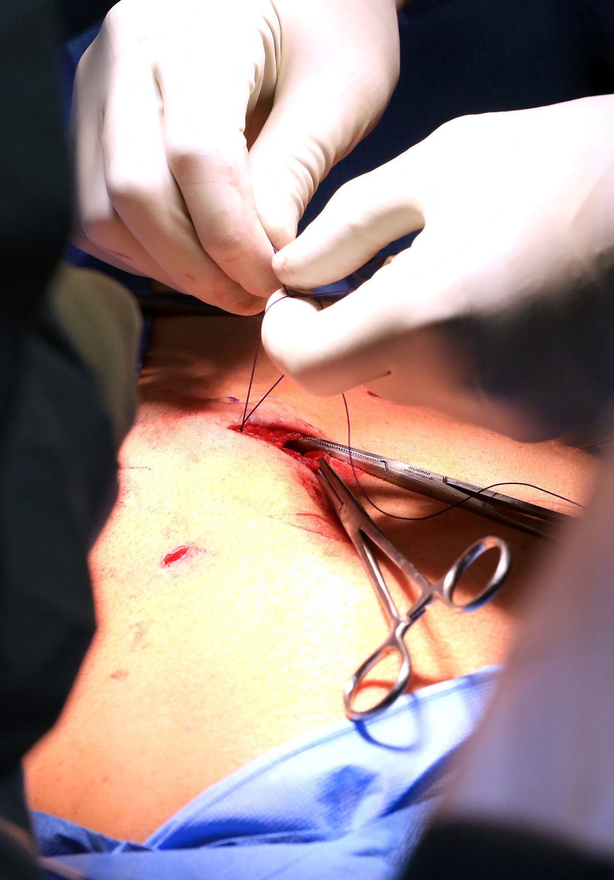 Robotic surgery